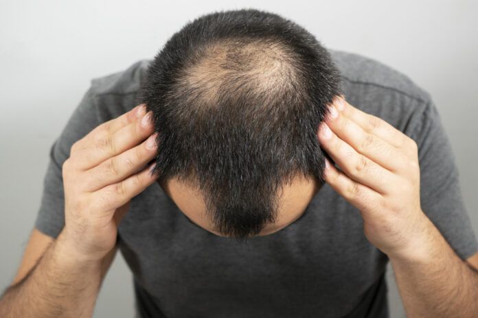 sparse hair and bald head problem on a grey background