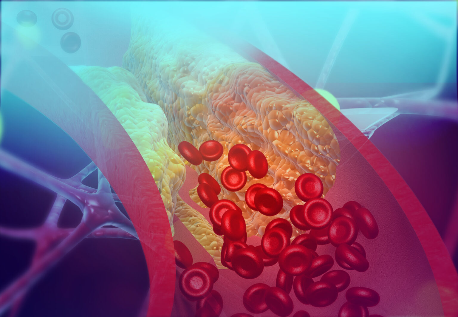 Should You Know Your Coronary Artery Calcium (CAC) Score? - Wellness Letter