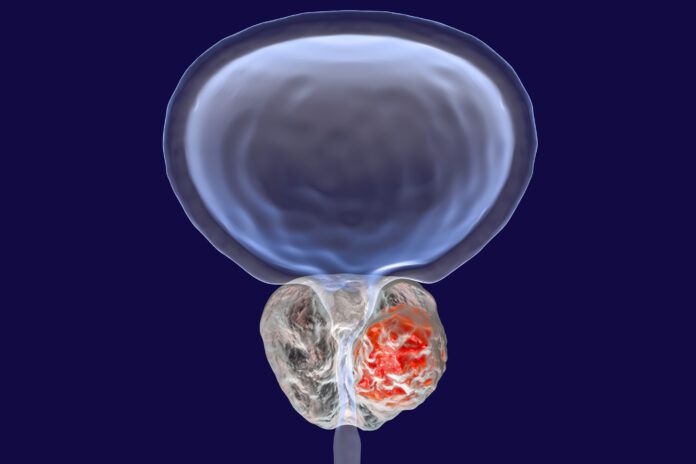 Prostate cancer illustration