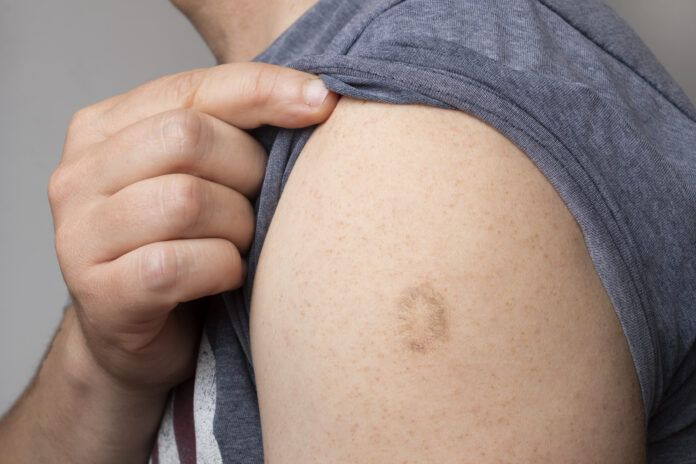 Monkeypox and smallpox vaccine scar on young man's arm
