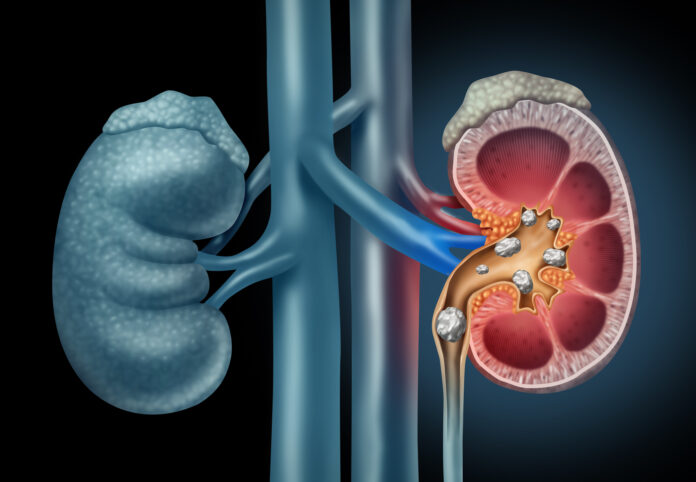 Added sugar may increase the risk of kidney stones
