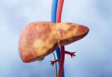 Fatty Liver Disease