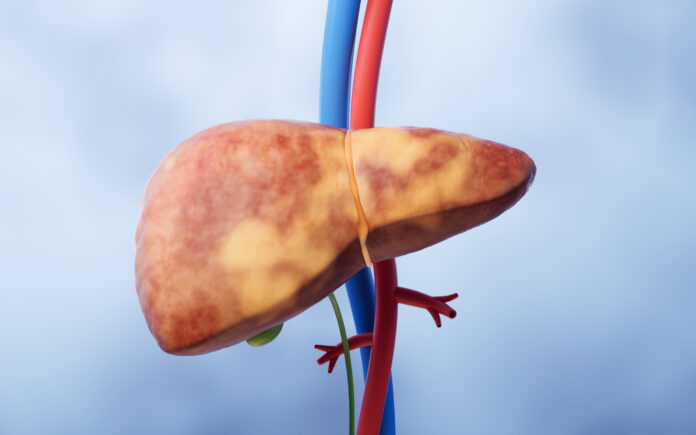 Fatty Liver Disease