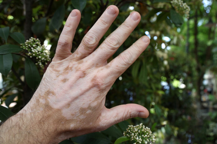 vitiligo