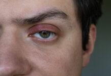 Blepharitis