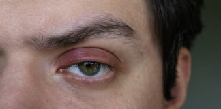 Blepharitis