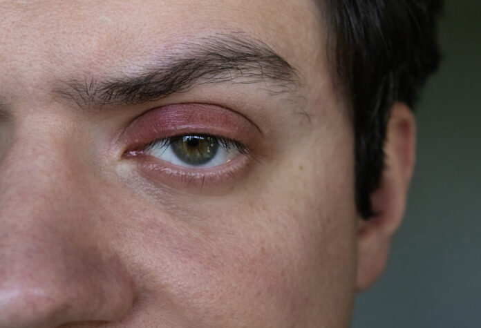 Blepharitis