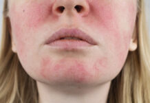 Getting Relief From Rosacea rosacea
