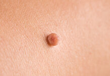 I Hate My Skin Tags! Can I Remove Them at Home? at-home skin tag remover
