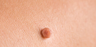 at-home skin tag remover